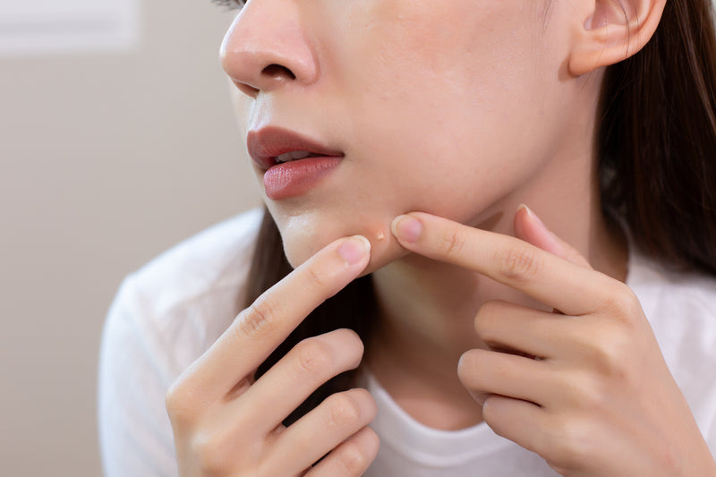 ANTI-ACNE